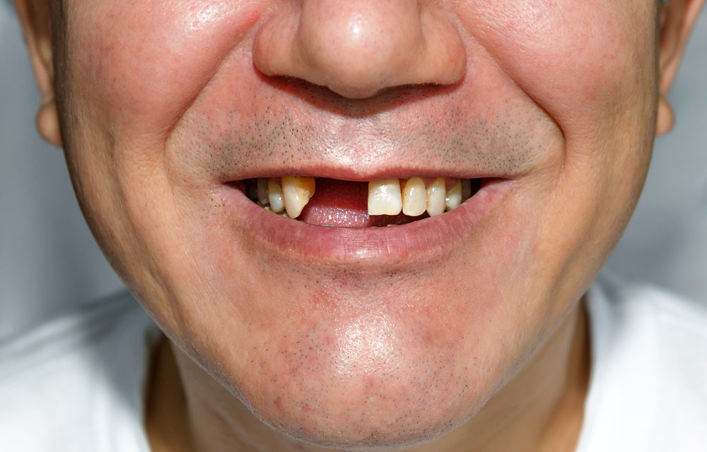 Ces 5 facteurs, qui accélèrent la perte de dents, vous feront reconsidérer vos habitudes