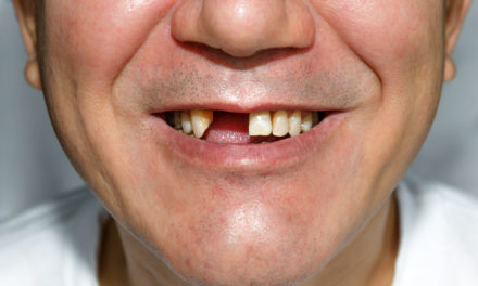 Ces 5 facteurs, qui accélèrent la perte de dents, vous feront reconsidérer vos habitudes